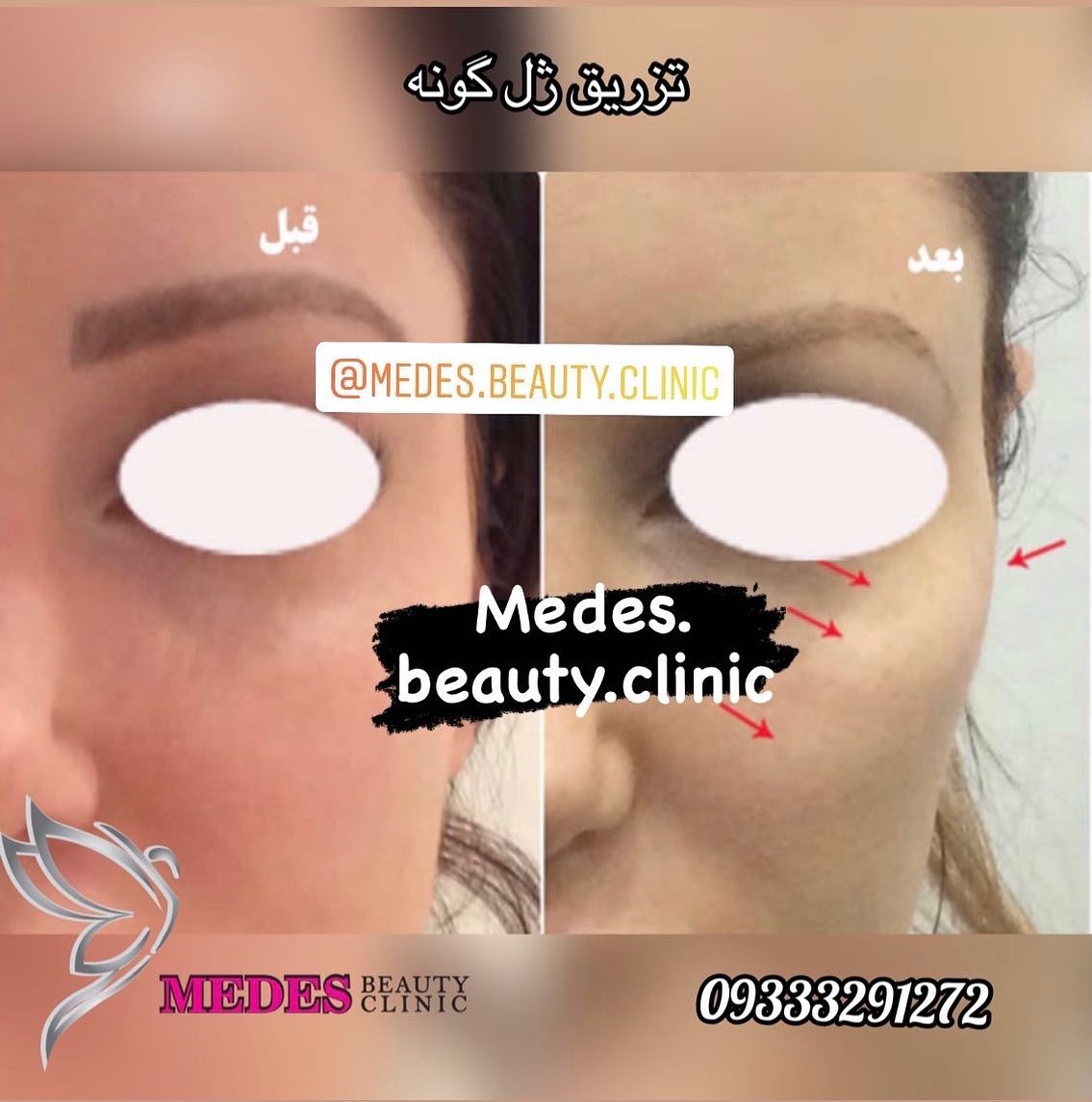 گالری زاویه سازی صورت